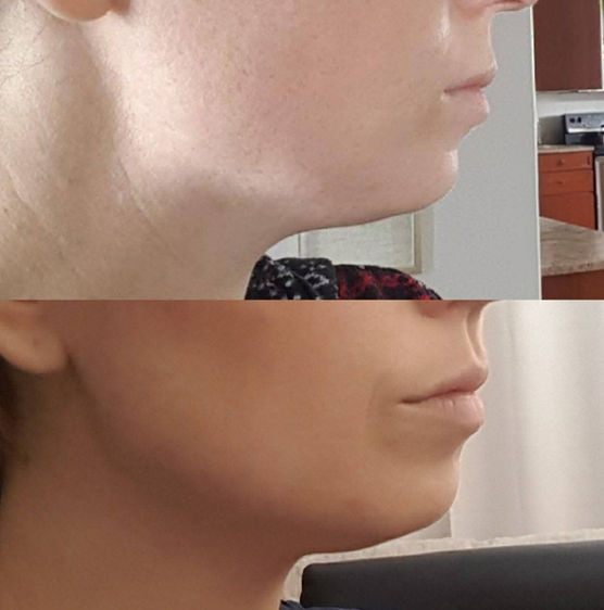 Manual lymphatic drainage result, image 2 of 3